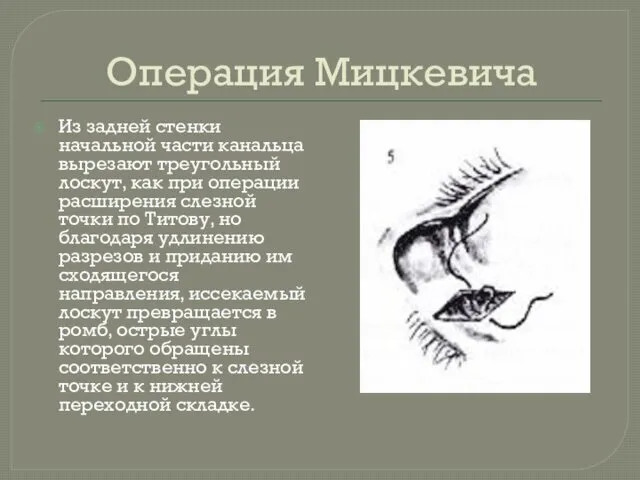 Операция Мицкевича Из задней стенки начальной части канальца вырезают треугольный лоскут,