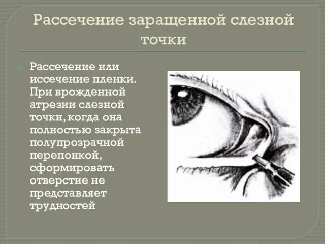 Рассечение заращенной слезной точки Рассечение или иссечение пленки. При врожденной атрезии