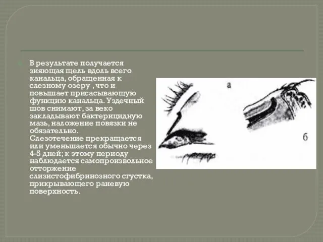 В результате получается зияющая щель вдоль всего канальца, обращенная к слезному