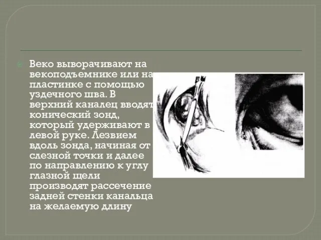 Веко выворачивают на векоподъемнике или на пластинке с помощью уздечного шва.