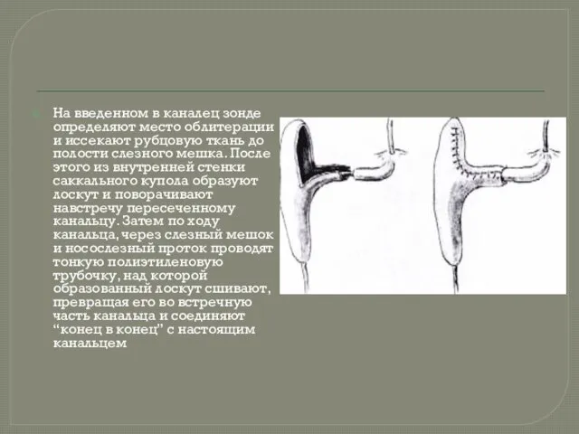 На введенном в каналец зонде определяют место облитерации и иссекают рубцовую