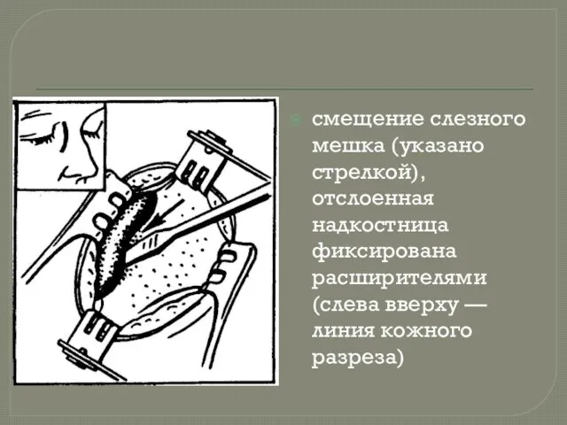 смещение слезного мешка (указано стрелкой), отслоенная надкостница фиксирована расширителями (слева вверху — линия кожного разреза)