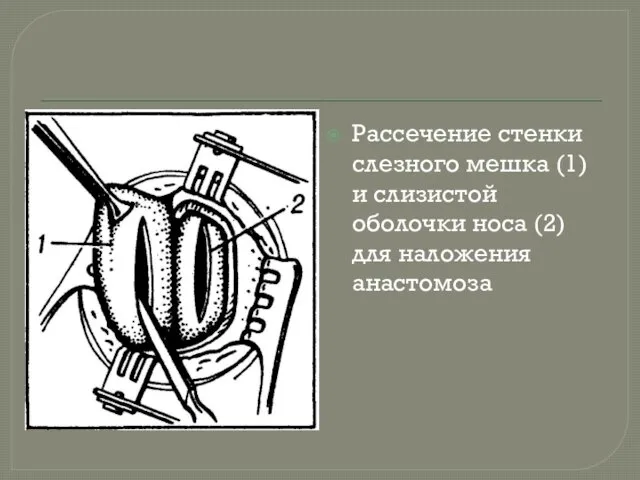 Рассечение стенки слезного мешка (1) и слизистой оболочки носа (2) для наложения анастомоза