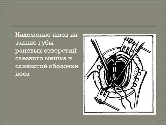 Наложение швов на задние губы раневых отверстий слезного мешка и слизистой оболочки носа