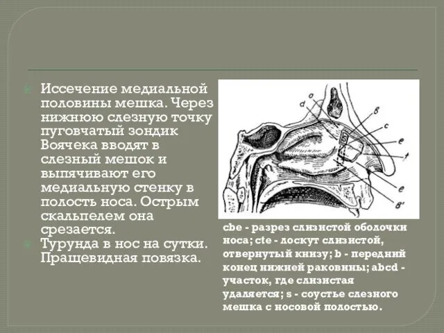 Иссечение медиальной половины мешка. Через нижнюю слезную точку пуговчатый зондик Воячека