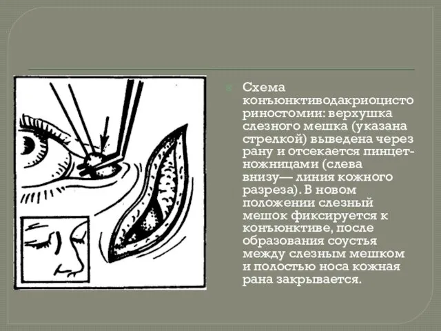 Схема конъюнктиводакриоцисториностомии: верхушка слезного мешка (указана стрелкой) выведена через рану и