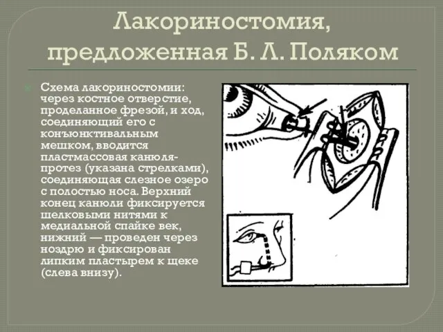 Лакориностомия, предложенная Б. Л. Поляком Схема лакориностомии: через костное отверстие, проделанное