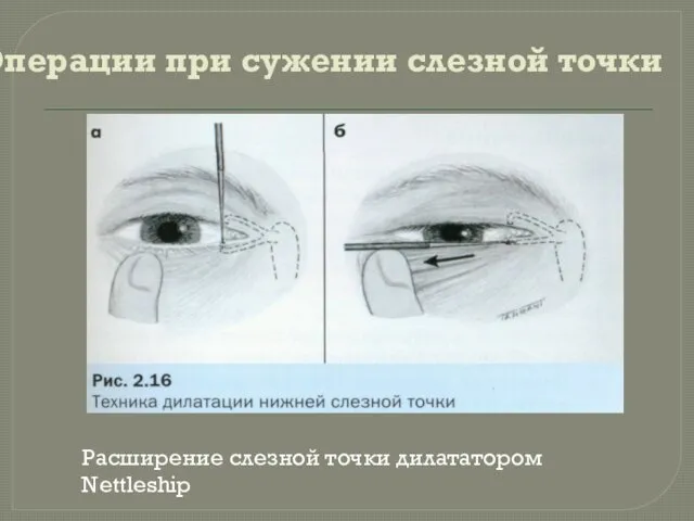 Операции при сужении слезной точки Расширение слезной точки дилататором Nettleship