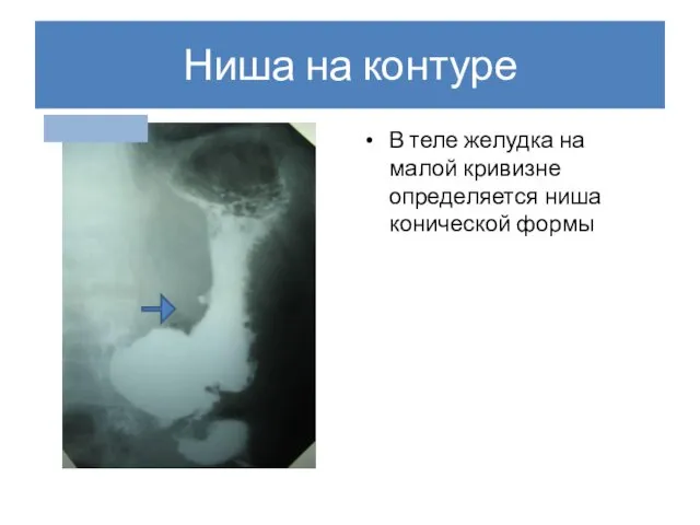 Ниша на контуре В теле желудка на малой кривизне определяется ниша конической формы