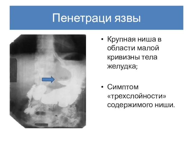 Пенетраци язвы Крупная ниша в области малой кривизны тела желудка; Симптом «трехслойности» содержимого ниши.