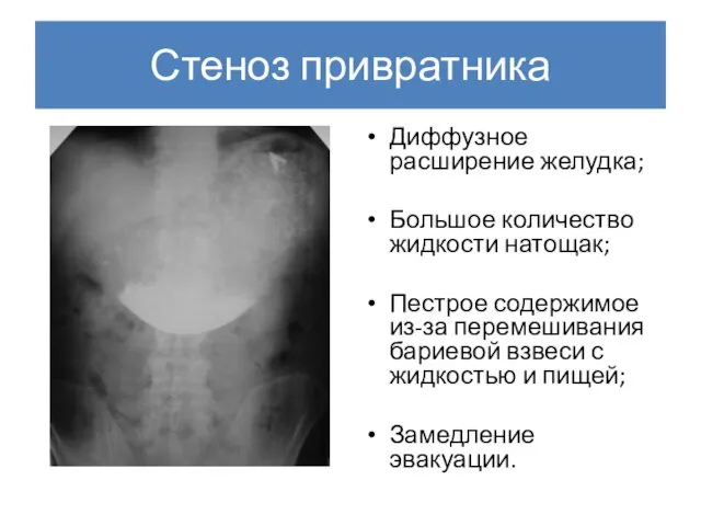 Стеноз привратника Диффузное расширение желудка; Большое количество жидкости натощак; Пестрое содержимое