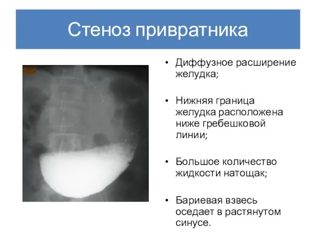 Стеноз привратника Диффузное расширение желудка; Нижняя граница желудка расположена ниже гребешковой