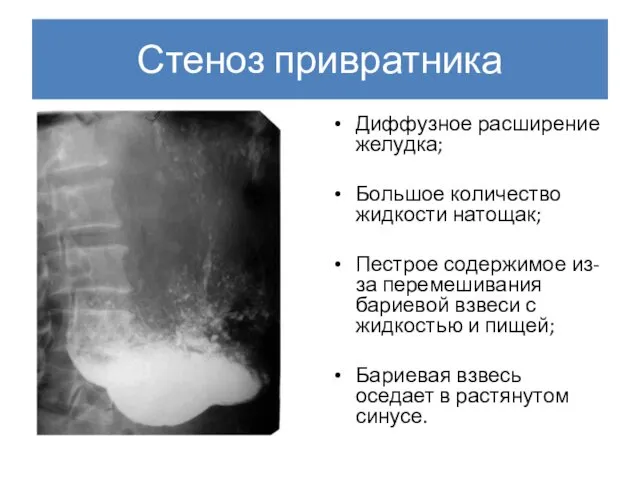 Стеноз привратника Диффузное расширение желудка; Большое количество жидкости натощак; Пестрое содержимое