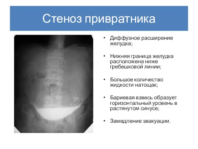 Стеноз привратника Диффузное расширение желудка; Нижняя граница желудка расположена ниже гребешковой