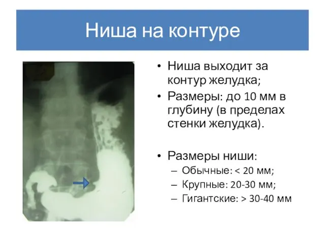 Ниша на контуре Ниша выходит за контур желудка; Размеры: до 10