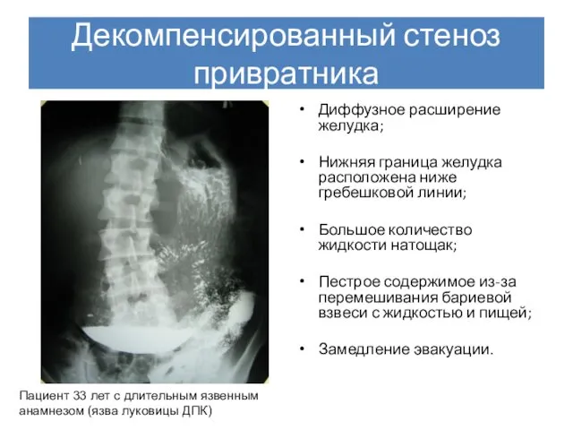 Декомпенсированный стеноз привратника Диффузное расширение желудка; Нижняя граница желудка расположена ниже