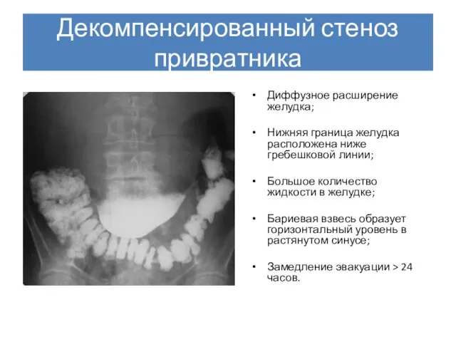 Декомпенсированный стеноз привратника Диффузное расширение желудка; Нижняя граница желудка расположена ниже