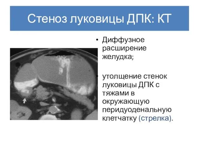 Стеноз луковицы ДПК: КТ Диффузное расширение желудка; утолщение стенок луковицы ДПК