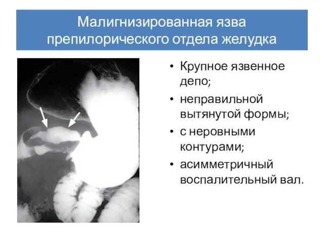 Малигнизированная язва препилорического отдела желудка Крупное язвенное депо; неправильной вытянутой формы;