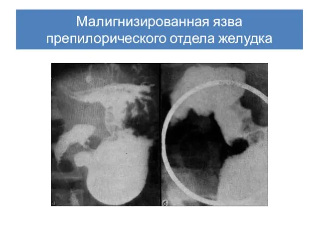 Малигнизированная язва препилорического отдела желудка