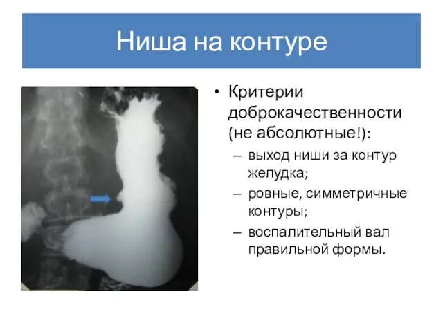 Ниша на контуре Критерии доброкачественности (не абсолютные!): выход ниши за контур