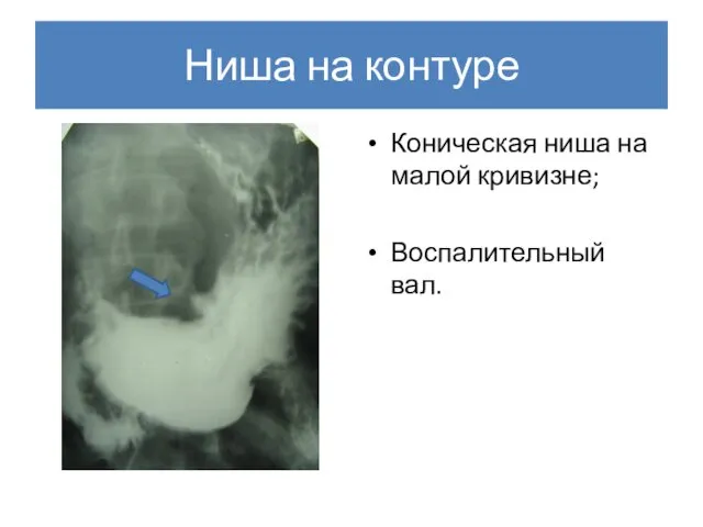 Ниша на контуре Коническая ниша на малой кривизне; Воспалительный вал.