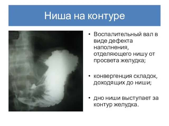 Ниша на контуре Воспалительный вал в виде дефекта наполнения, отделяющего нишу