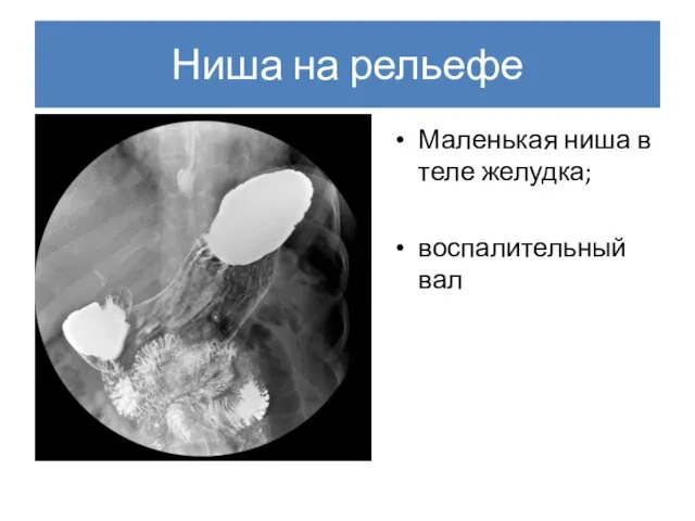 Ниша на рельефе Маленькая ниша в теле желудка; воспалительный вал