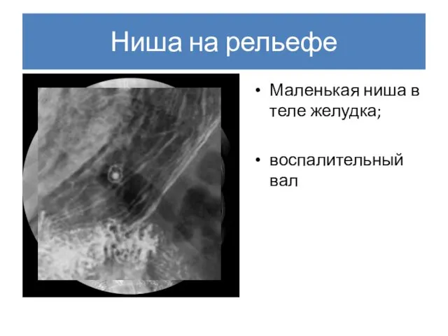 Ниша на рельефе Маленькая ниша в теле желудка; воспалительный вал