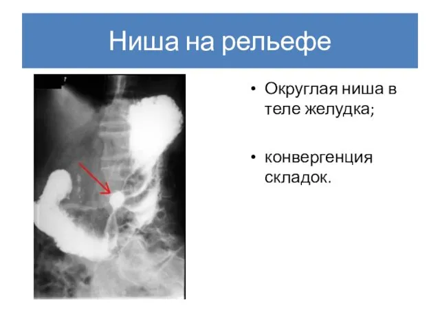 Ниша на рельефе Округлая ниша в теле желудка; конвергенция складок.