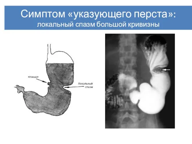 Симптом «указующего перста»: локальный спазм большой кривизны