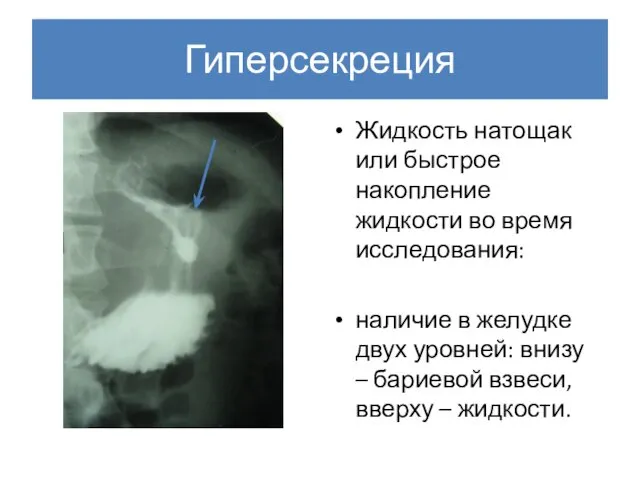 Гиперсекреция Жидкость натощак или быстрое накопление жидкости во время исследования: наличие