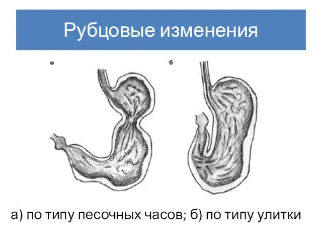 Рубцовые изменения а) по типу песочных часов; б) по типу улитки