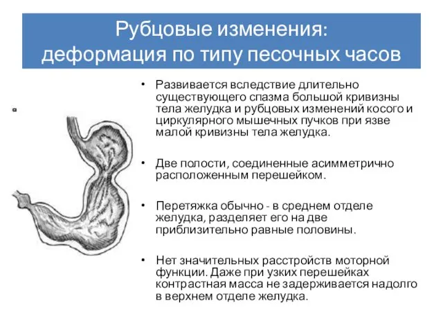 Рубцовые изменения: деформация по типу песочных часов Развивается вследствие длительно существующего