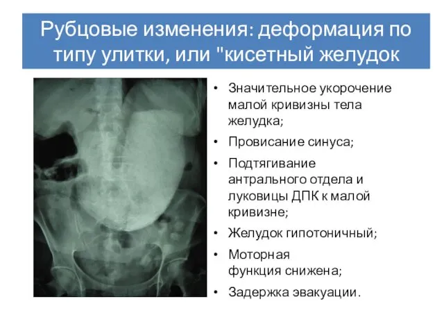 Рубцовые изменения: деформация по типу улитки, или "кисетный желудок Значительное укорочение