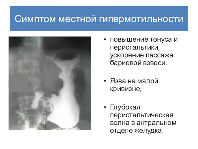 Симптом местной гипермотильности повышение тонуса и перистальтики, ускорение пассажа бариевой взвеси.