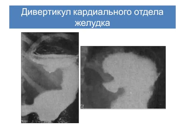 Дивертикул кардиального отдела желудка