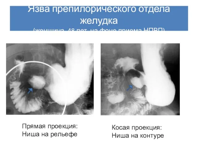 Язва препилорического отдела желудка (женщина, 48 лет, на фоне приема НПВП)