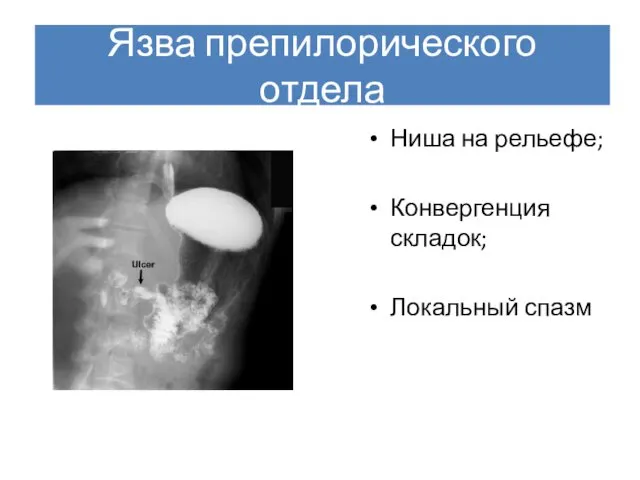 Язва препилорического отдела Ниша на рельефе; Конвергенция складок; Локальный спазм