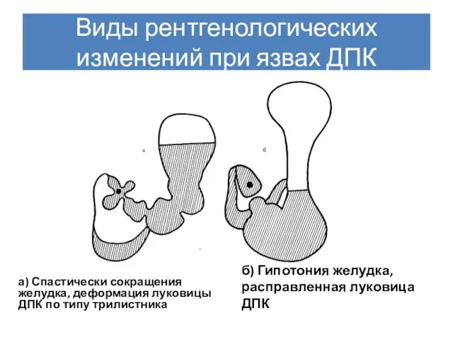 Виды рентгенологических изменений при язвах ДПК а) Спастически сокращения желудка, деформация