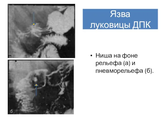 Язва луковицы ДПК Ниша на фоне рельефа (а) и пневморельефа (б).