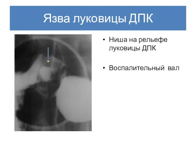 Язва луковицы ДПК Ниша на рельефе луковицы ДПК Воспалительный вал