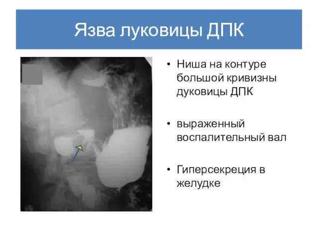 Язва луковицы ДПК Ниша на контуре большой кривизны дуковицы ДПК выраженный воспалительный вал Гиперсекреция в желудке