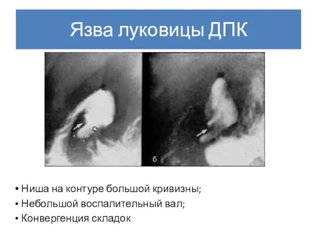 Язва луковицы ДПК Ниша на контуре большой кривизны; Небольшой воспалительный вал; Конвергенция складок