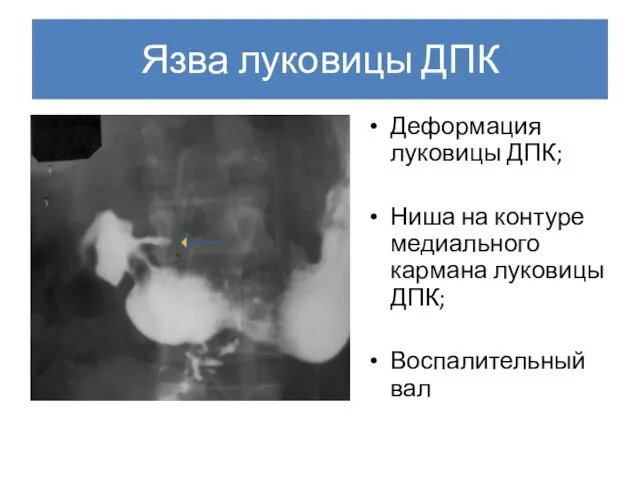 Язва луковицы ДПК Деформация луковицы ДПК; Ниша на контуре медиального кармана луковицы ДПК; Воспалительный вал