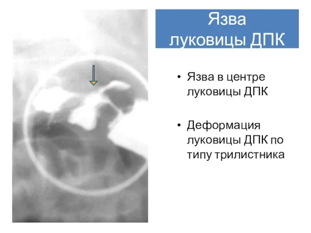 Язва луковицы ДПК Язва в центре луковицы ДПК Деформация луковицы ДПК по типу трилистника