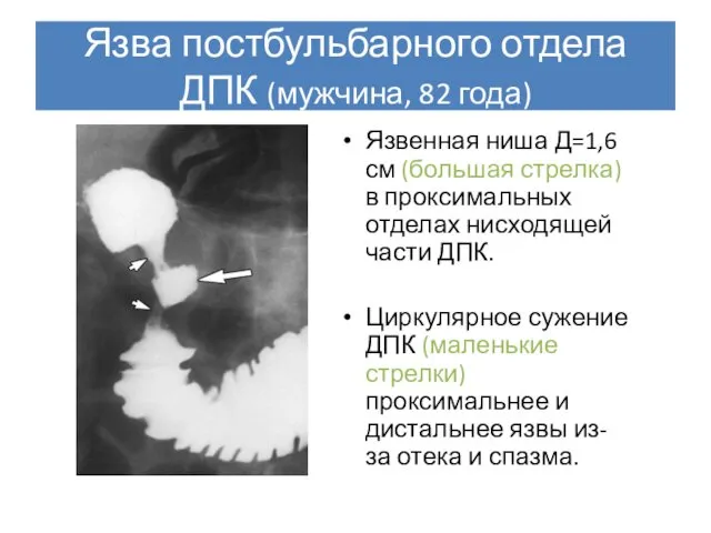 Язва постбульбарного отдела ДПК (мужчина, 82 года) Язвенная ниша Д=1,6 см