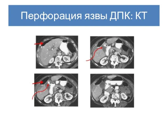 Перфорация язвы ДПК: КТ