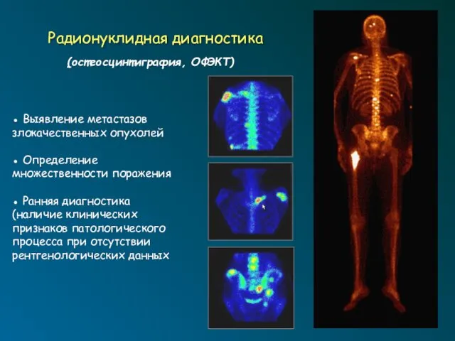Радионуклидная диагностика (остеосцинтиграфия, ОФЭКТ) ● Выявление метастазов злокачественных опухолей ● Определение