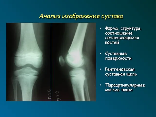 Анализ изображения сустава Форма, структура, соотношение сочленяющихся костей Суставные поверхности Рентгеновская суставная щель Параартикулярные мягкие ткани